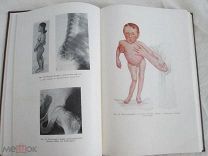 ДВУХТОМНИК ОРТОПЕДИЯ,1957 Г! ИЗУМИТЕЛЬНОЕ ИЗДАНИЕ